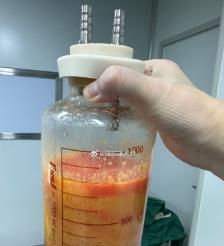 睢县水动力吸脂手术要做多久？